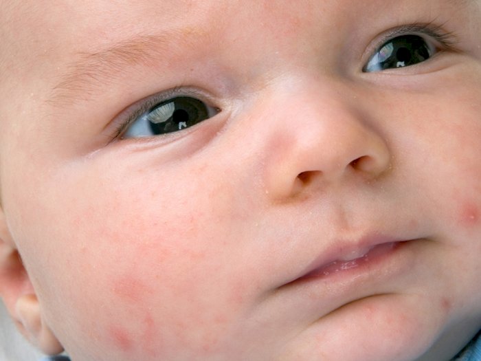 5 Tips Atasi Eczema Pada Bayi
