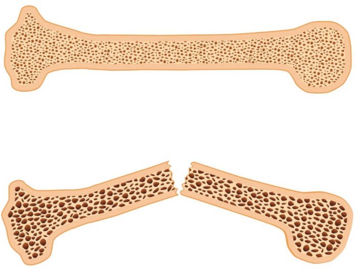 Ketahui, Risiko Osteoporosis Bisa Disebabkan Karena  Sabun
