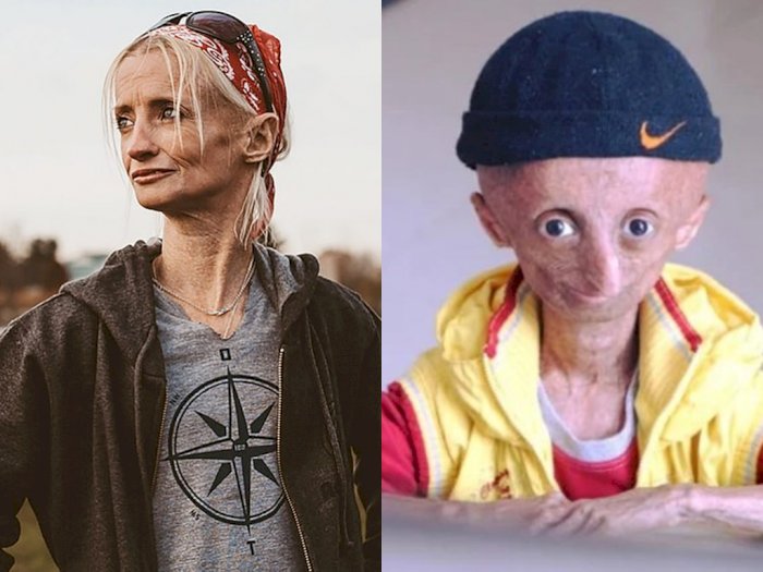 Berikut Tiga Anak yang Alami Sindrom Progeria