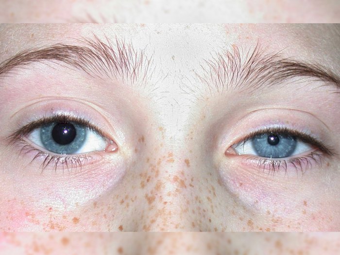 Anisocoria Kondisi Medis Yang Membuat Ukuran Pupil Berbeda Indozone Id