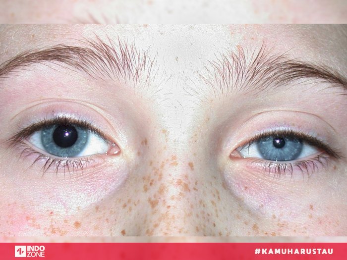 Anisocoria, Kondisi Medis Yang Membuat Ukuran Pupil Berbeda Indozone.id
