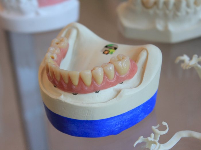 Usai Menjalani Operasi Gigi Palsu Pria Ini Nyangkut di Tenggorokan