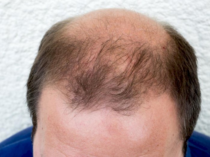 Inilah Tips Ampuh Mengatasi Kebotakan Rambut