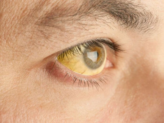 Benarkah Mata Kuning Tanda Terkena Hepatitis A?
