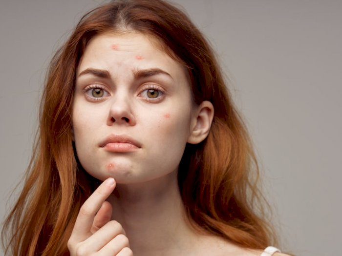 5 Kandungan Skincare yang Harus Dihindari oleh Kulit Berjerawat