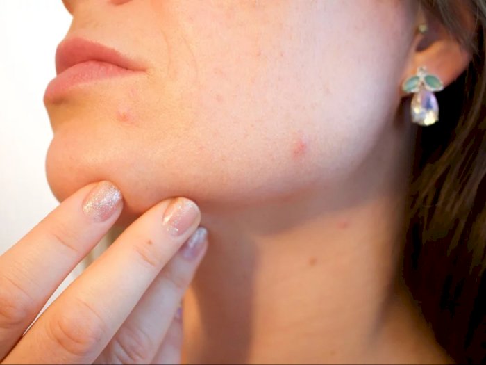 4 Kandungan Skincare yang Ampuh Mengatasi Jerawat