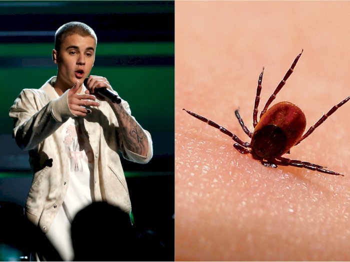 Mengenal Penyakit Lyme Seperti yang Diderita Justin Bieber