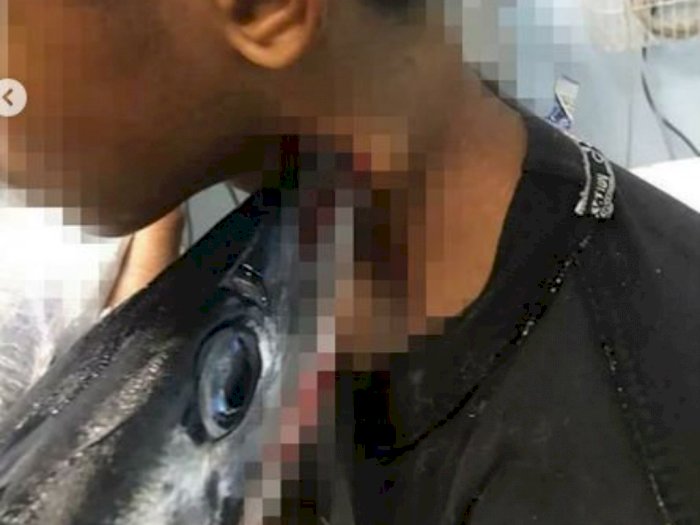 Asyik Melaut, Moncong Ikan Sori Terbang Tertancap di Leher Remaja Ini