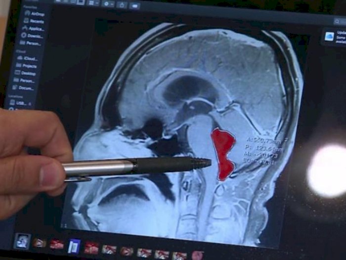 Sakit Kepala Tak Sembuh-sembuh, Ternyata  Ada Cacing Pita di Otak