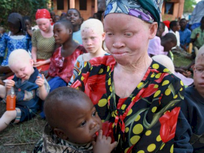 Kisah Kelam Orang-orang Albino yang Diburu dan Dibunuh di Tanzania
