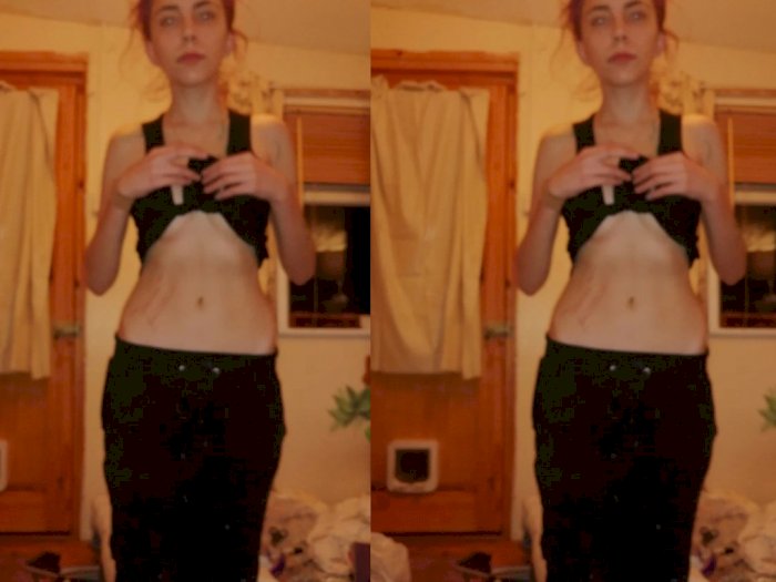 Seorang Gadis Alami Gangguan Makan Anoreksia,  Sejak Usianya 15 Tahun