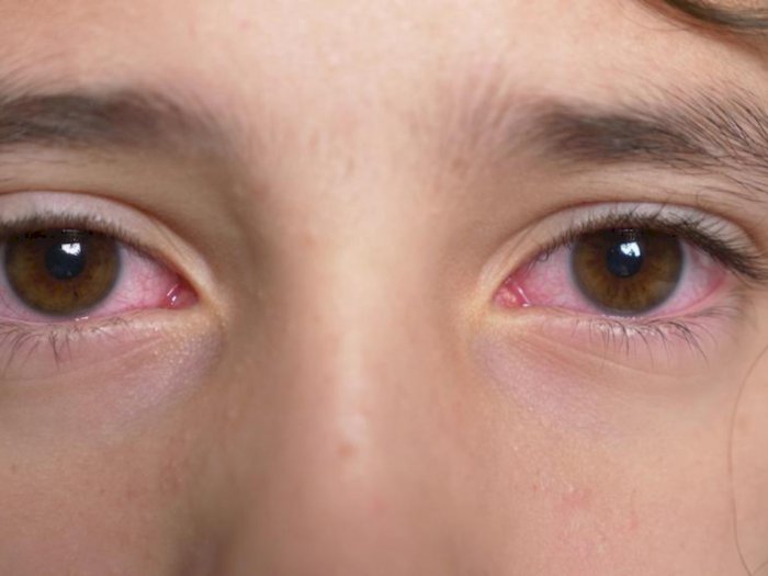 Benarkah Mata Merah Juga Gejala dari Virus Corona?