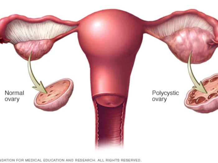 Apa Itu Sindrom Ovarium Polikistik? Kenali Gejala dan Cara Penanganannya