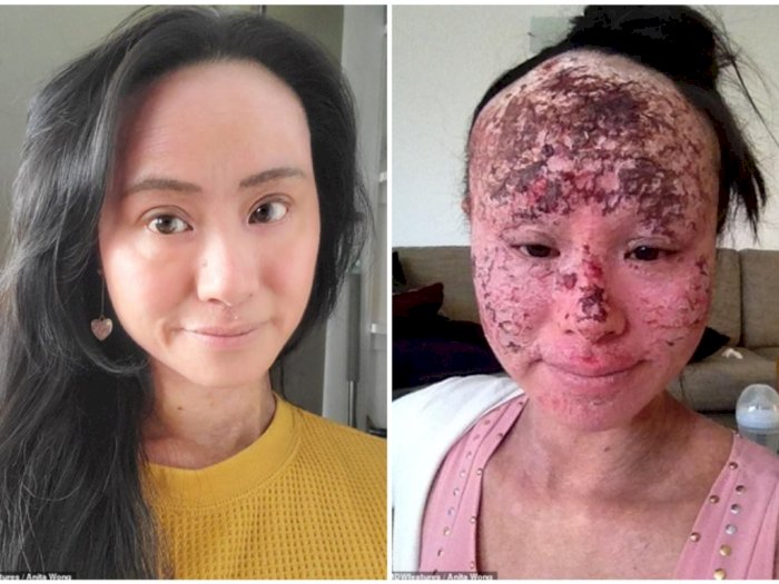 Terlalu Sering Pakai Obat untuk Sembuhkan Eczema, Wajah Perempuan Ini Jadi Hancur
