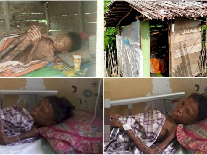 Kisah Dua Bocah Yatim Piatu, Adik Rawat Abangnya di Gubuk Karena Terjangkit Penyakit Aneh