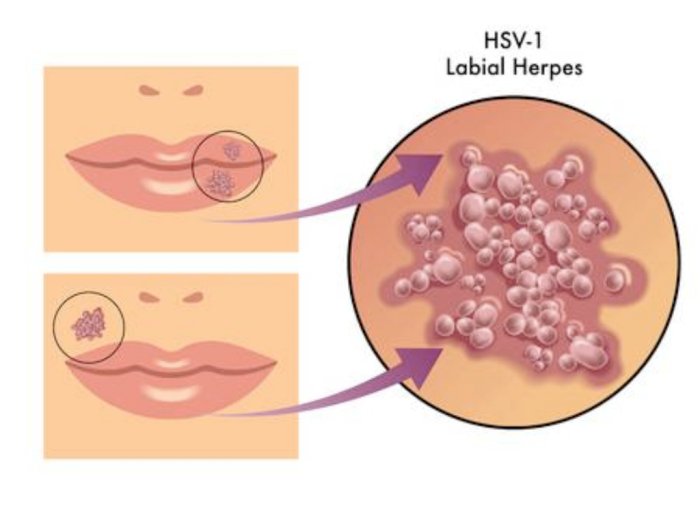 Herpes: Gejala, Penyebab dan Pengobatannya