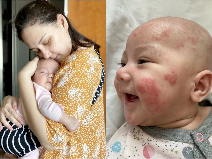 Anaknya Alami Ruam karena Dermatitis Atopik, Ini yang Perlu Dilakukan kata Mona Ratuliu