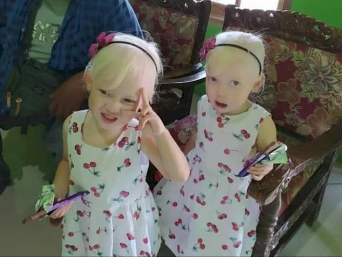 Heboh Anak Kembar Albino di Wonogiri, Si Ibu Dikira Selingkuh dengan