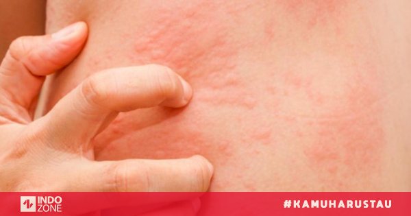 Kudis Scabies Penyebab Penularan Gejala Diagnosis Pengobatan Dan