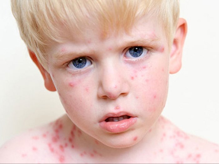 Penyakit Cacar (Smallpox): Penyebab, Gejala, Pengobatan, dan Pencegahan
