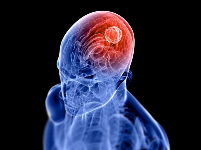 Tumor Otak: Jenis, Penyebab, Gejala, Diagnosis dan Pengobatan