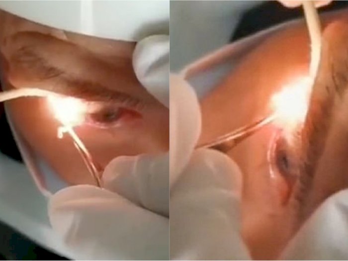 Mengeluh Sakit Mata, Dokter Keluarkan 20 Cacing Gelang dari Mata Pria Ini, Ini Videonya