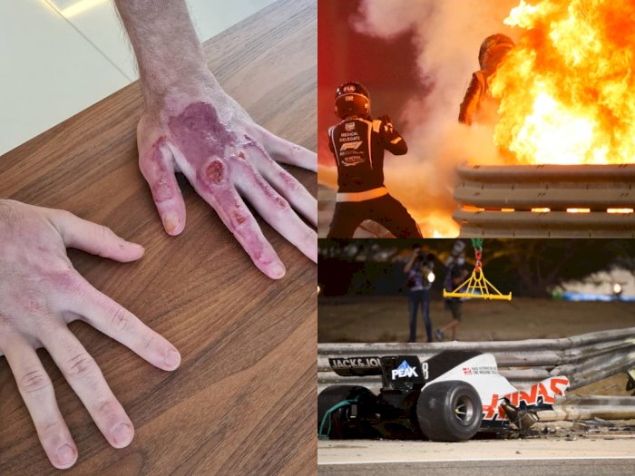 Bintang F1 Ini Tunjukkan Cedera Tangannya Usai Alami Kecelakaan saat Mobil Terbelah Dua