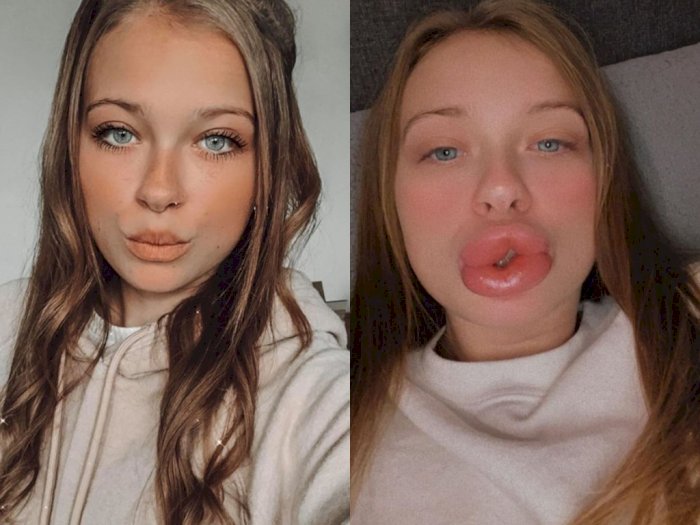 Bibir Wanita Ini Bengkak Setelah Lakukan Filler Bibir Murah