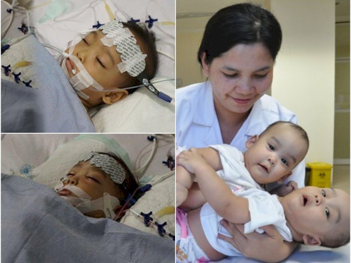 Mengharukan Bayi Kembar Siam di Medan, Hasil Operasinya Bikin Harap-Harap Cemas