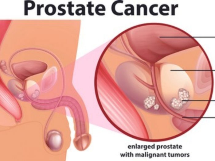 Penyakit prostat