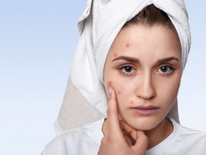 Ganti Skincare Buat Wajah Berjerawat, Purging atau Breakout? 