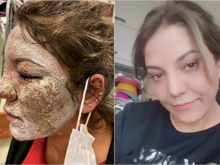 Bukan Tambah Cantik, Wajah Wanita Ini Justru Terbakar Setelah Perawatan di Sebuah Klinik