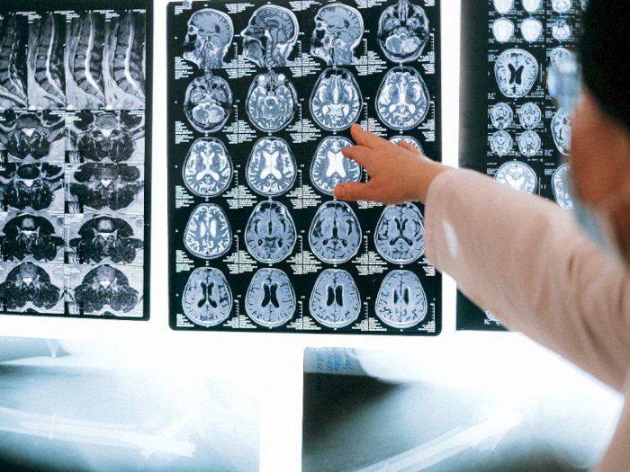 Peneliti Kembangkan Projek Baru untuk Rawat Pasien dengan Kerusakan Otak Sekunder