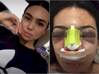 Operasi Hidung Gagal, Wanita Ini Hampir Meninggal karena Tengkoraknya Tertusuk
