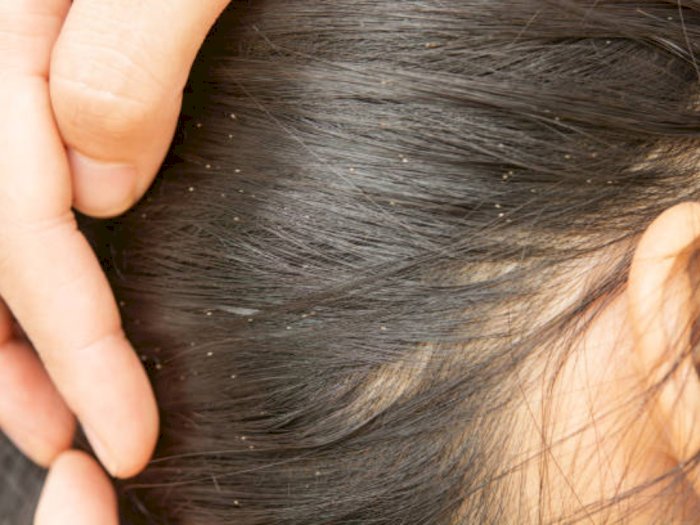 Cara Menghilangkan Kutu Rambut Beserta Telurnya, Terbukti Manjur! |  Indozone.id