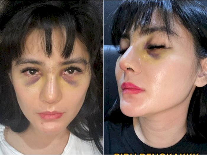 Potret Wajah Bengkak Angela Lee Usai Operasi Hidung Jadi Sorotan, Matanya Membiru