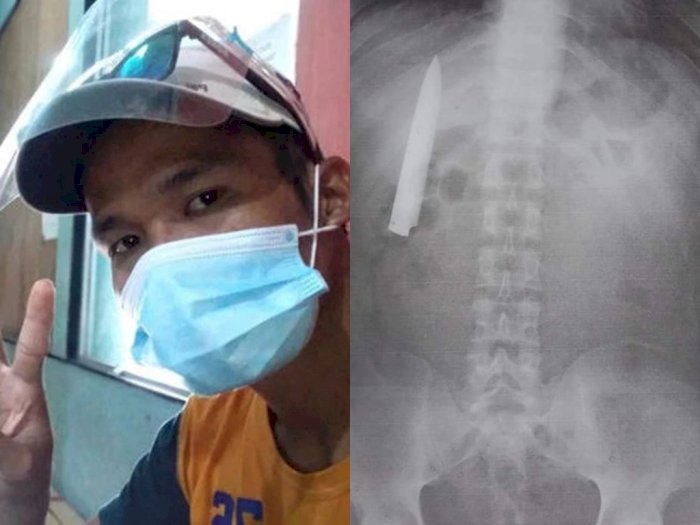Pria Lakukan X-Ray untuk Lamaran Kerja, Malah Temukan Pisau Terjebak di Dadanya