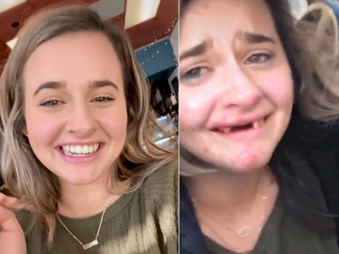 Nahas! Wanita Cantik Ini Kehilangan Giginya Akibat Terjatuh Usai Banyak Minum Alkohol