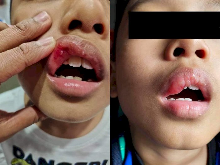 Siswa 7 Tahun Ini Ditampar Gurunya karena Menangis, Bibir Terluka dan Bengkak