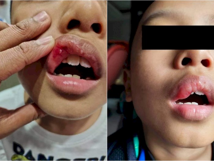 Siswa SD di Malaysia Ini Alami Bibir Bengkak Setelah Guru Menamparnya Karena Menangis