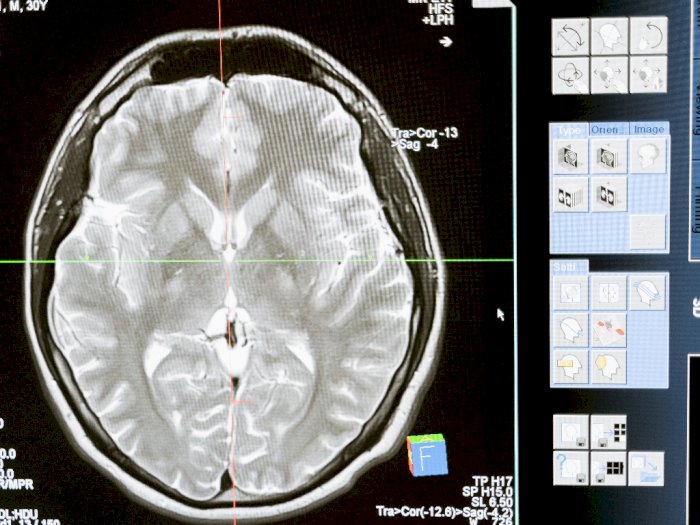 Peneliti Kembangkan Alat Implan untuk Bantu Pencitraan Optik pada Otak!