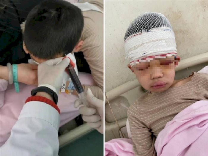 Guru di Tiongkok Ini Tarik Rambut Muridnya Sampai Kulit Kepala dan Tengkorak Terpisah