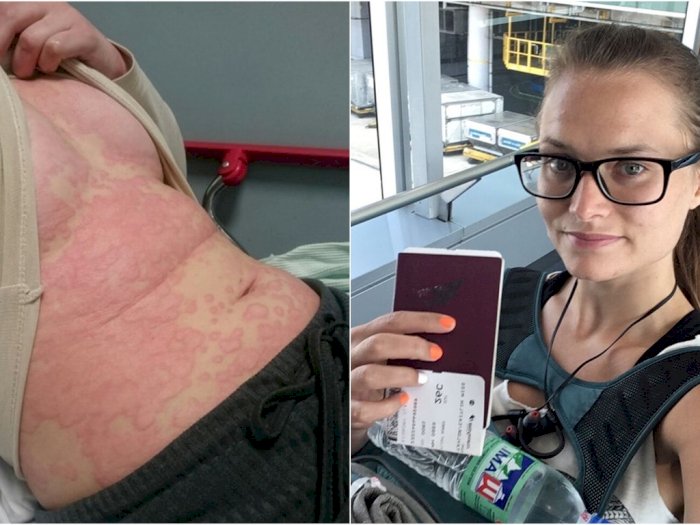 Alami Alergi Serius, Penyakit Wanita Ini Sembuh Setelah Liburan Keliling Dunia