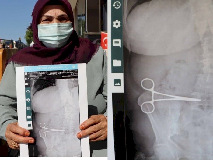 Bikin Ngilu, Sebuah Gunting Tertinggal di Dalam Perut Ibu Ini Usai Jalani Operasi