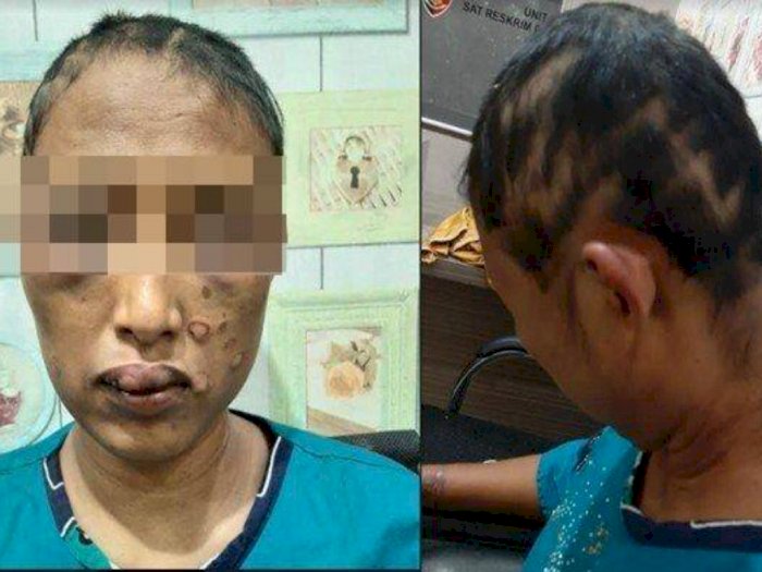 Pilu Kondisi Wanita yang Dimasuki Cobek Kemaluannya oleh Suaminya, Kepalanya Digunduli