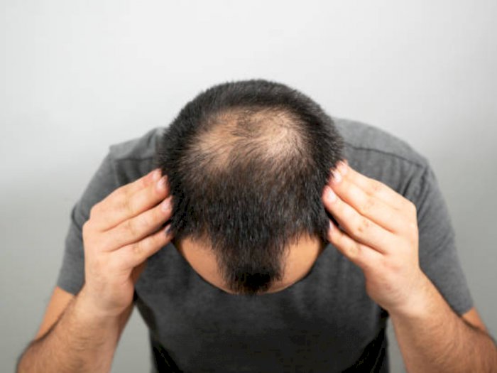 Cara Menumbuhkan Rambut Botak dan Rontok dengan Cepat | Indozone.id