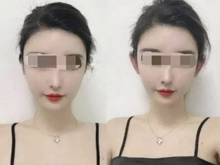 Viral Tren Kecantikan 'Telinga Peri ' di China, Membuat Muka Jauh Lebih Muda dan Tirus