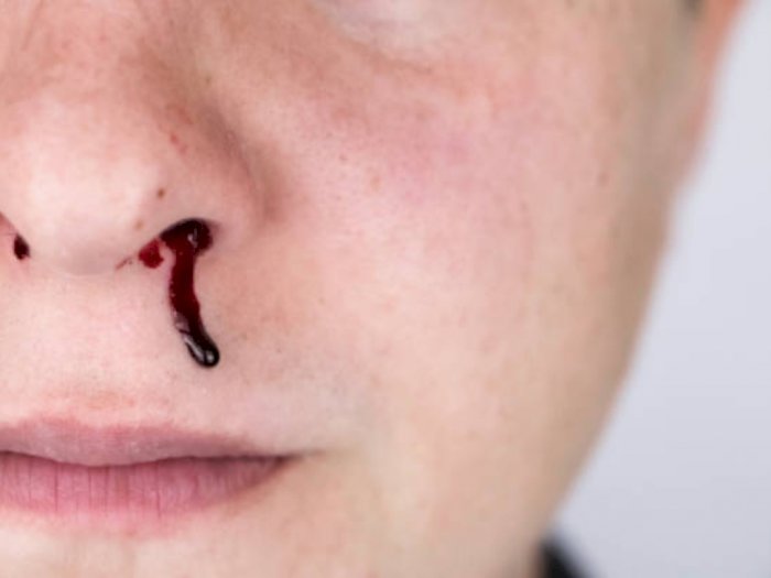 Cara Mengatasi Mimisan dan Menghentikan Pendarahan di Hidung