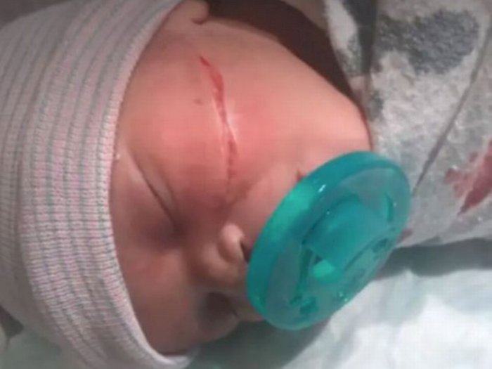 Kasihan, Bayi Perempuan Ini Alami Luka di Wajahnya karena Operasi Caesar Gagal