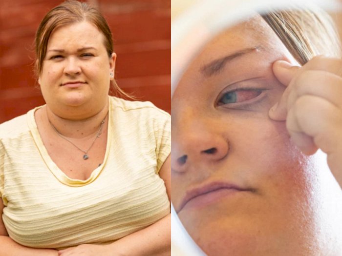 Wanita Ini Hampir Kehilangan Penglihatan Setelah Mengira Lem Kuku Adalah Obat Tetes Mata